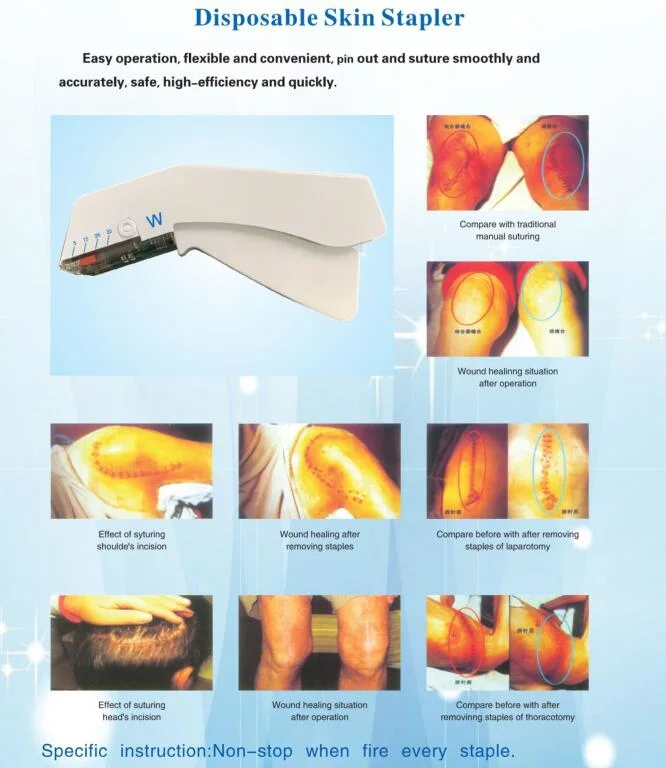 New Type Disposable Medical Skin Stapler